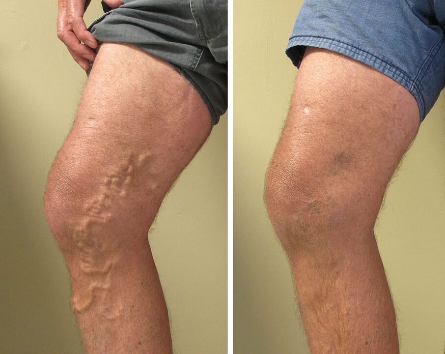 Experiencia de usar gel zxcvbnmqwert
