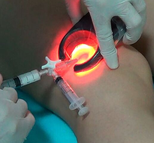 Tratamento de varices