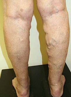 varices nas pernas