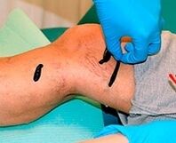 Sanguijuelas para varices