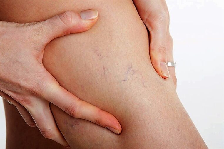 Cuadrícula varices na perna