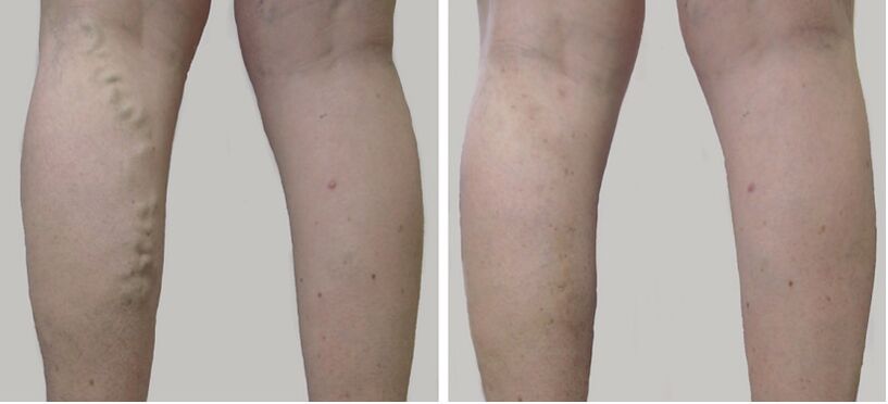 Antes e despois do tratamento