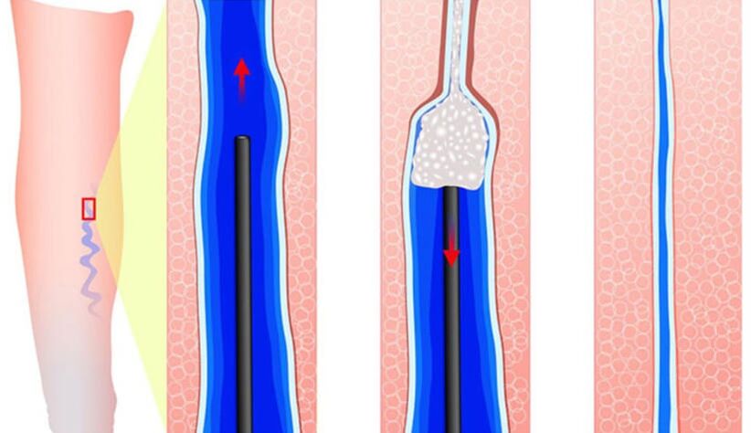 Introdución do esclerosante en escleroterapia