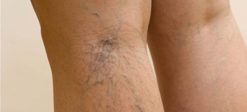 Varices nas pernas