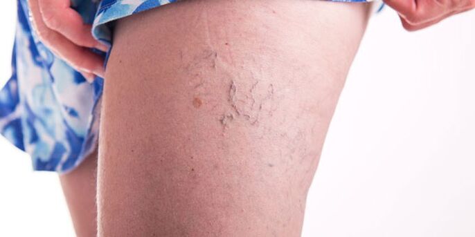 Formas de tratar as varices
