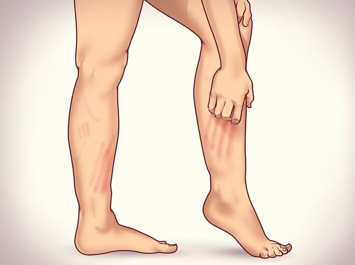 6 signos non obvios de varices